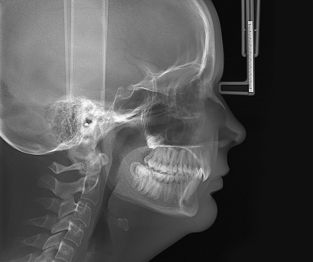 OP-3D_X-ray_LAT-PED-head1_1000px.jpeg