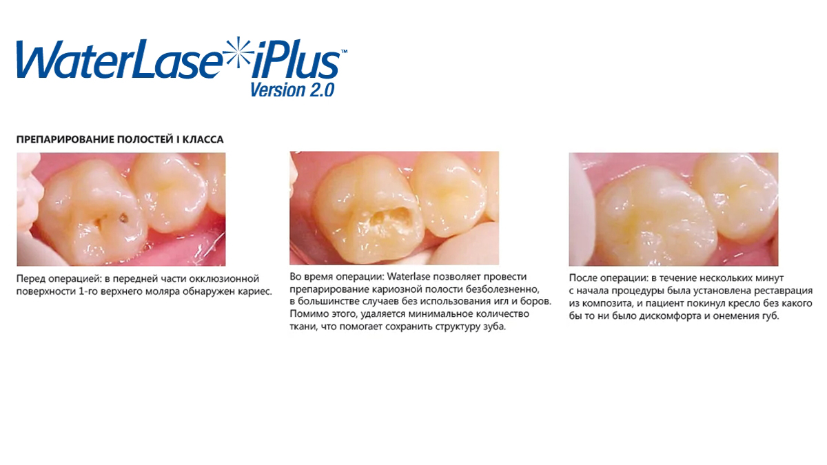 Процедуры на твердых тканях