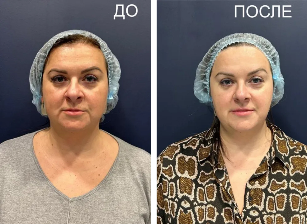 Процедура Full face