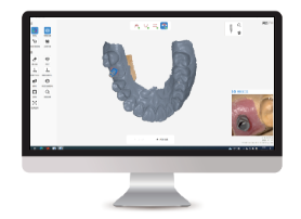Умная обработка скана имплантата