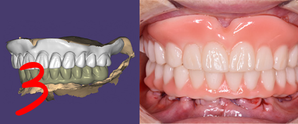 Проектирование и печать временных протезов