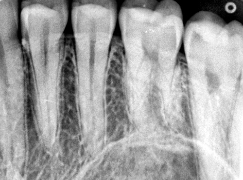 Фокальное пятно