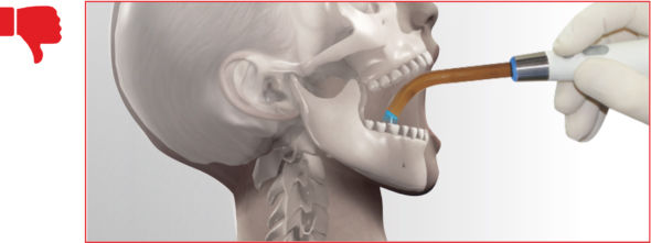 Стоматологический фотоактиватор
