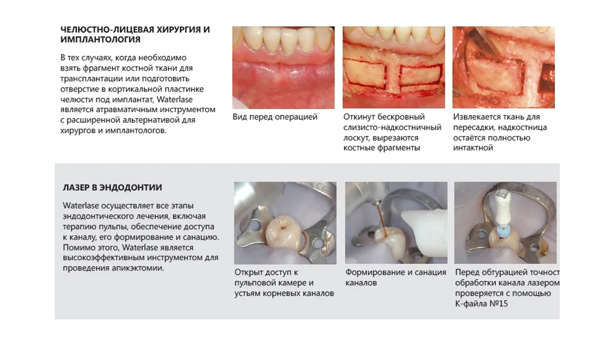 Применение лазера