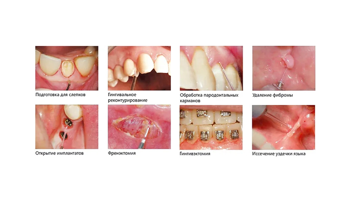 Процедуры на мягких тканях