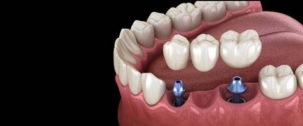 Определение оптимального соотношения челюстей для пациентов с адентией