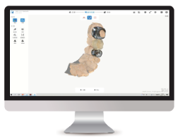 Сканирование зубов с металлическими реставрациями