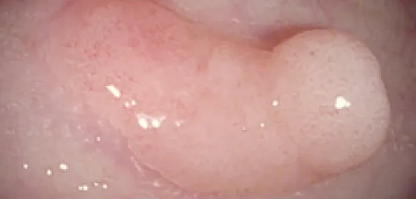 Повышение чёткости поверхности слизистой