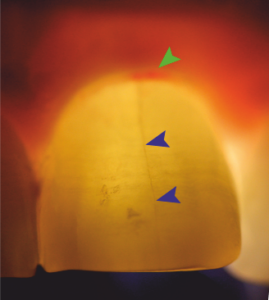 Трансиллюминация