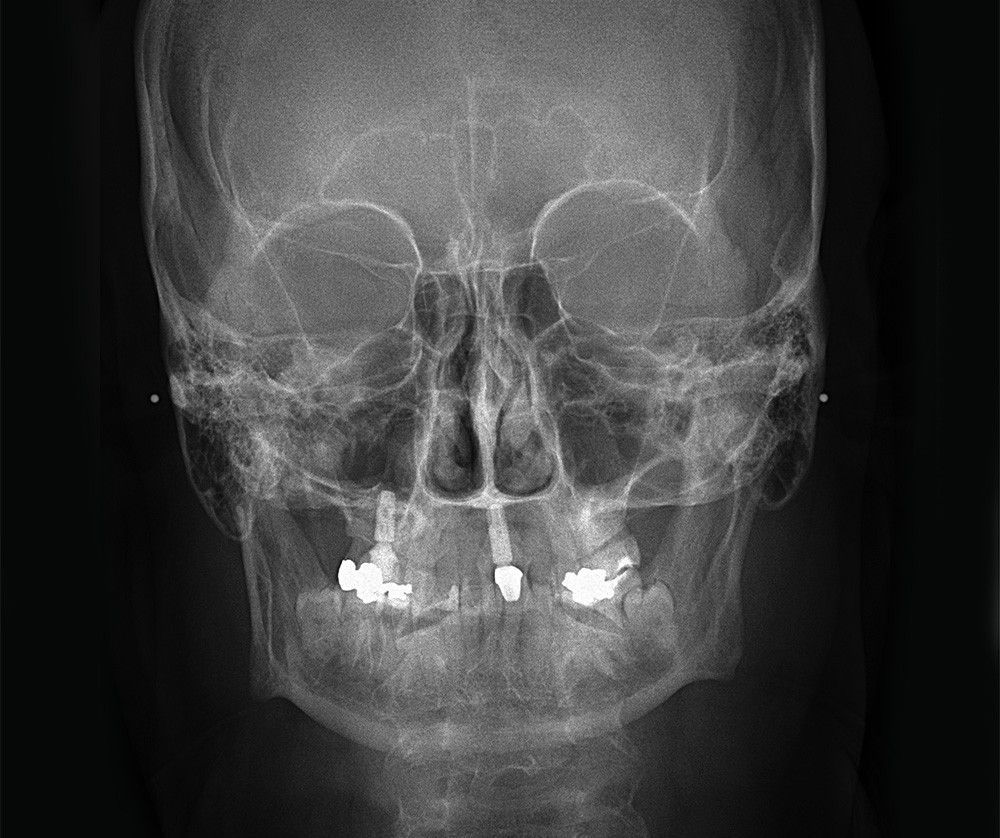 OP-3D_X-ray_PA-head-front_1000px.jpeg