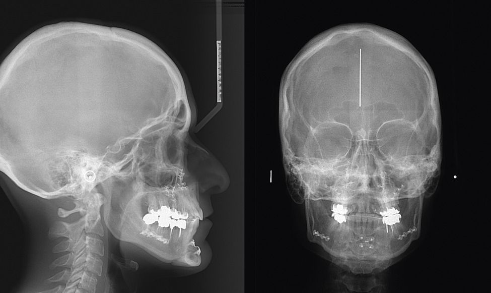 Изображения боковой проекции используют для изучения прикуса и его коррекции, а также для изучения аномалий строения челюстей (лишние зубы, неправильно выросшие зубы, отсутствие зубных единиц и так далее).